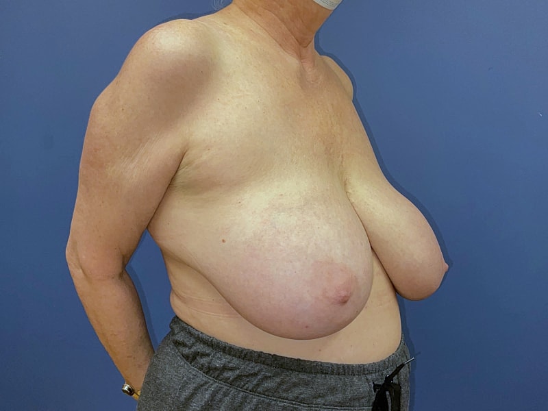 Breast Reduction Before & After