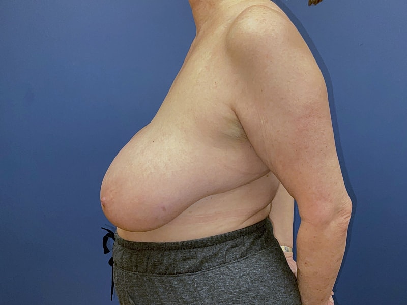 Breast Reduction Before & After
