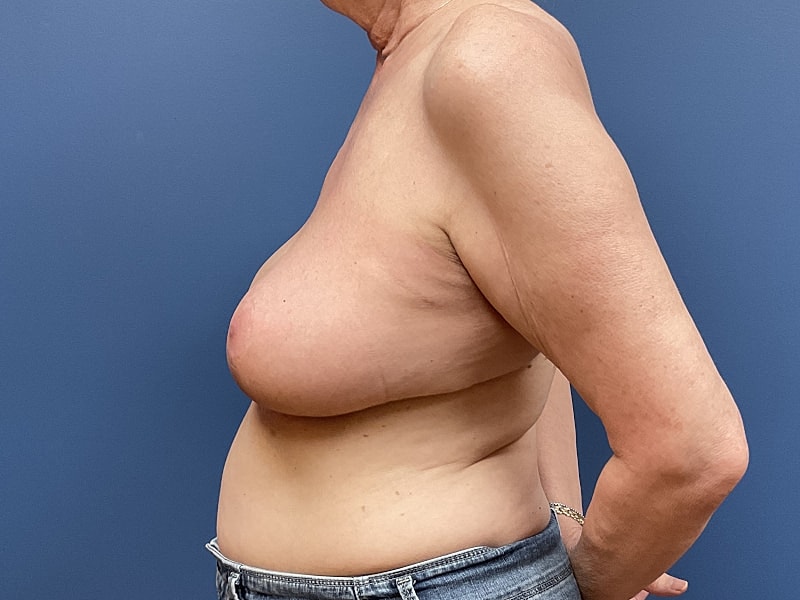 Breast Reduction Before & After