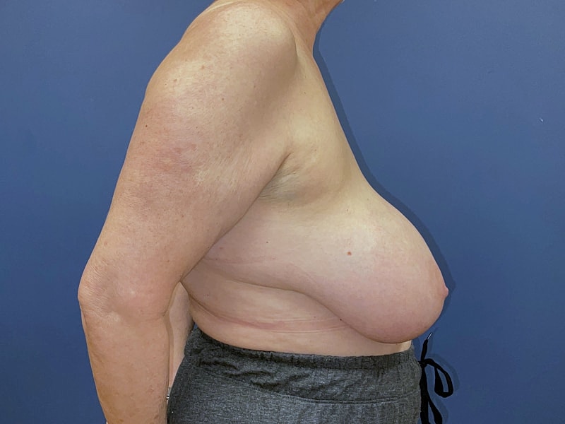 Breast Reduction Before & After