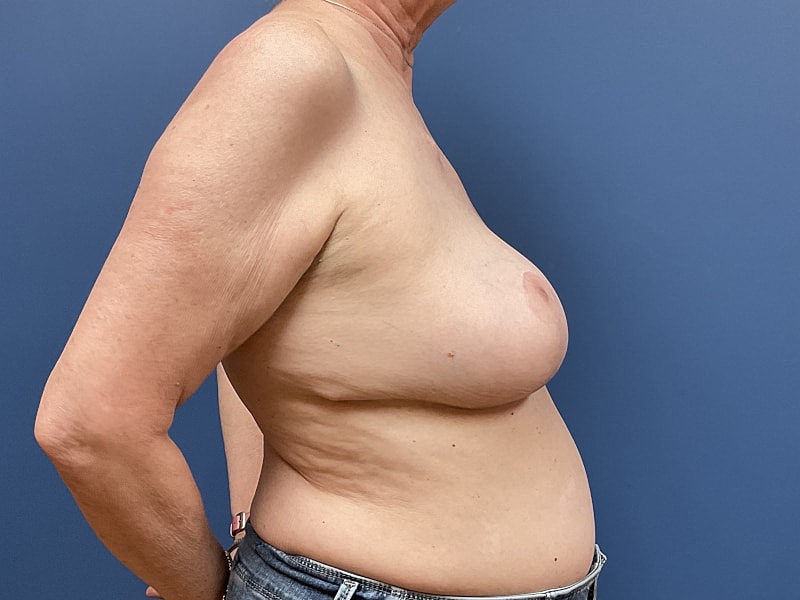 Breast Reduction Before & After