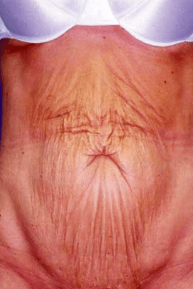 After Weight Loss Surgery Before & After