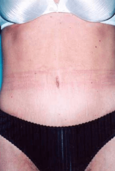 After Weight Loss Surgery Before & After