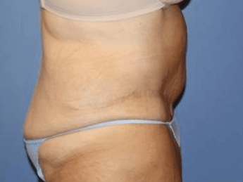 After Weight Loss Surgery Before & After