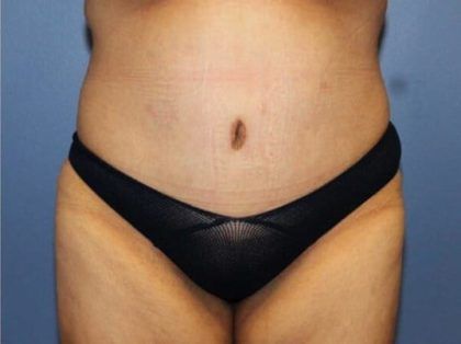 After Weight Loss Surgery Before & After