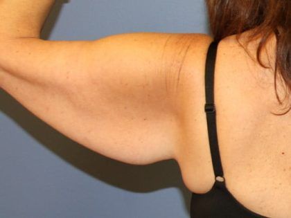 After Weight Loss Surgery Before & After