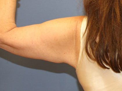 After Weight Loss Surgery Before & After