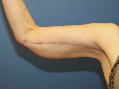 After Weight Loss Surgery Before & After