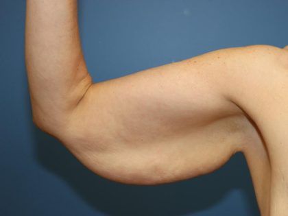 After Weight Loss Surgery Before & After