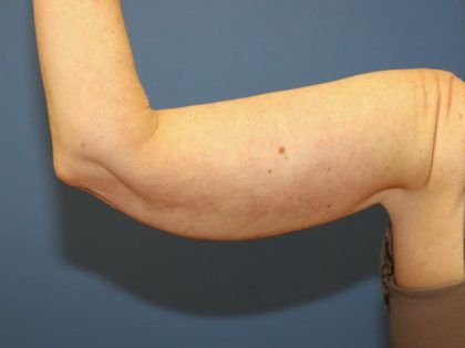 After Weight Loss Surgery Before & After