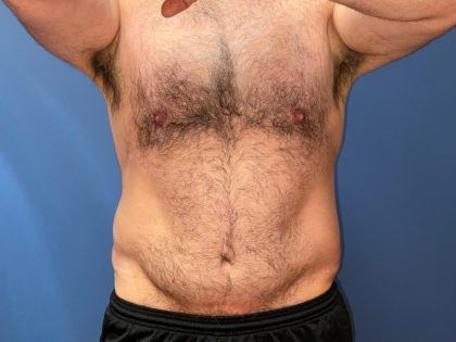 After Weight Loss Surgery Before & After