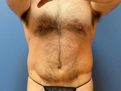 After Weight Loss Surgery Before & After