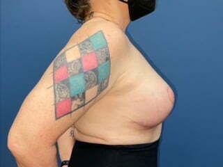 Breast Revision Before & After