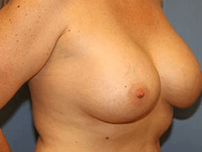 Breast Revision Before & After