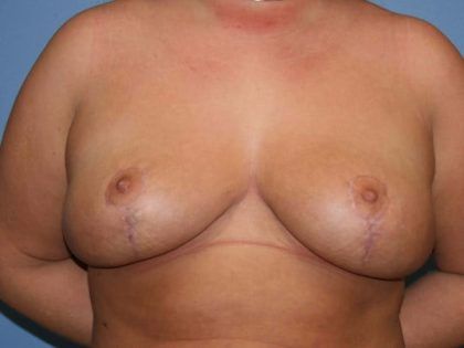 Breast Revision Before & After
