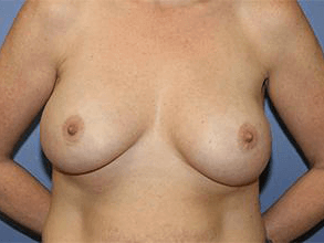 Breast Revision Before & After