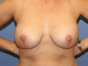 Breast Revision Before & After