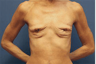 Breast Revision Before & After