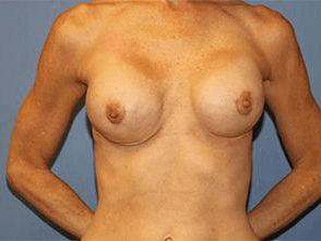 Breast Revision Before & After