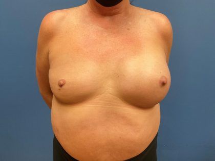 Breast Revision Before & After