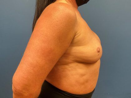 Breast Revision Before & After