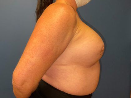 Breast Revision Before & After