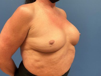 Breast Revision Before & After