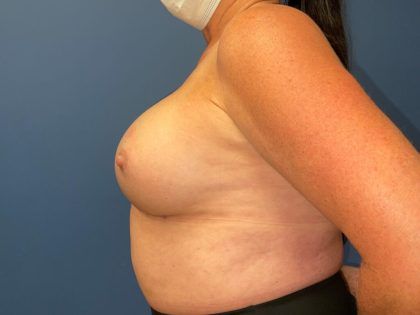 Breast Revision Before & After