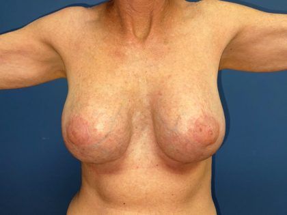Breast Revision Before & After