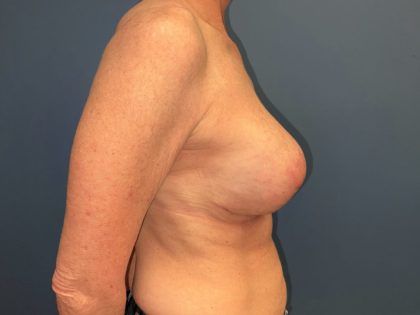 Breast Revision Before & After