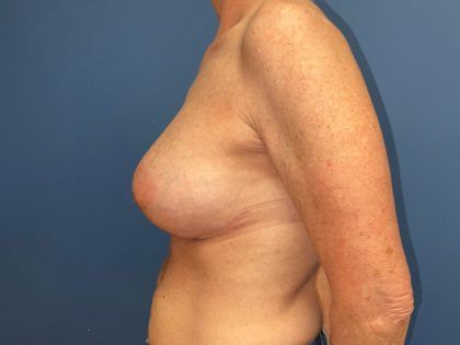 Breast Revision Before & After