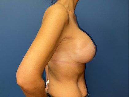 Breast Revision Before & After