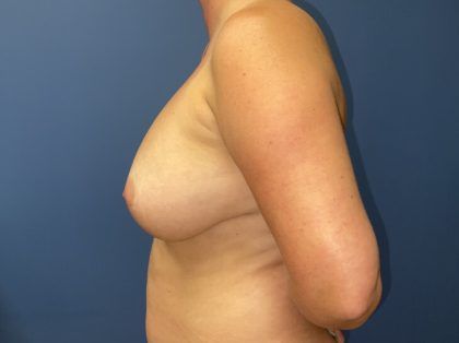 Breast Revision Before & After