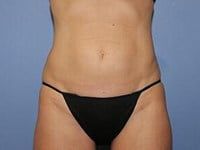 Coolsculpting Before & After
