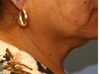 Coolsculpting Before & After