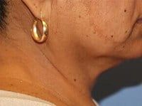 Coolsculpting Before & After