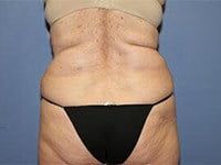 Coolsculpting Before & After