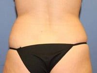 Coolsculpting Before & After