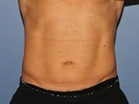 Coolsculpting Before & After