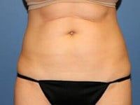 Coolsculpting Before & After