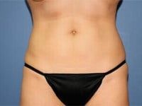 Coolsculpting Before & After