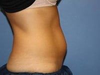 Coolsculpting Before & After