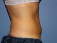 Coolsculpting Before & After