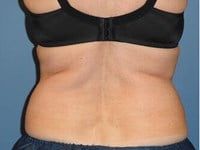 Coolsculpting Before & After