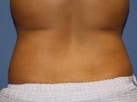 Coolsculpting Before & After