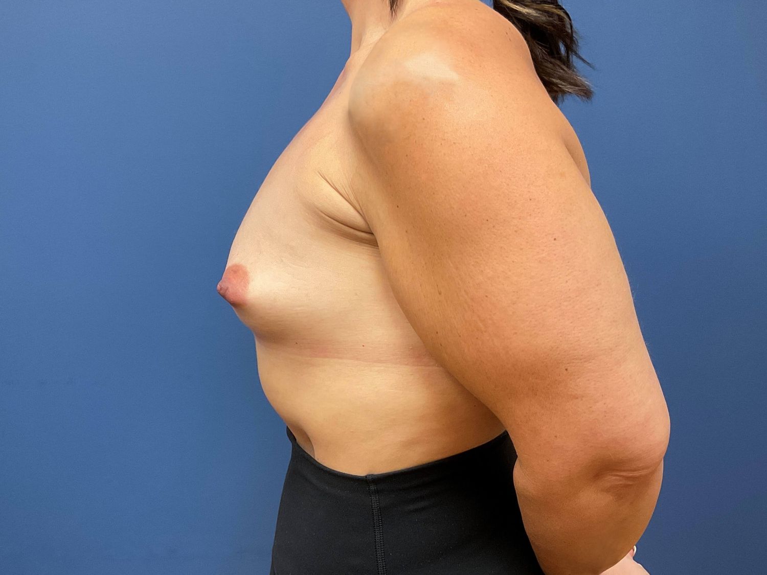 Breast Lift With Implants Before & After