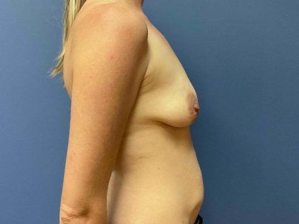 Breast Lift With Implants Before & After