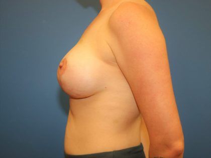 Breast Lift With Implants Before & After