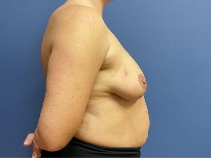 Breast Lift With Implants Before & After
