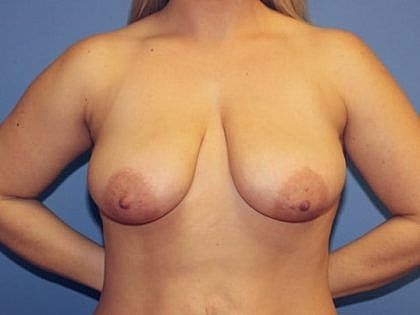 Nude upper body of a woman, front view.